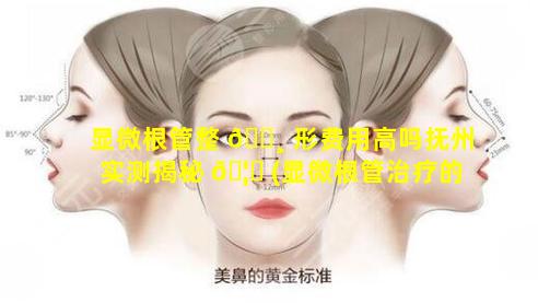 显微根管整 🕸 形费用高吗抚州实测揭秘 🦍 (显微根管治疗的优点和缺点)